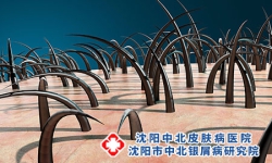 头上银屑病用什么保湿?