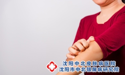 牛皮癣会很痒吗？