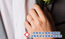 牛皮血癣会传染吗，沈阳治银屑病医院优选中北
