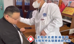 沈阳看银屑病，面部银屑病如何治疗