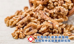 沈阳银屑病研究所中北:气虚牛皮癣患者食疗调养