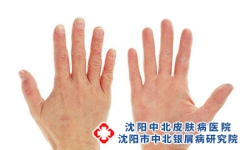 为什么银屑病会烂手指?
