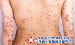 有银屑病要注意什么？全方位生活护理指南