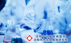 牛皮癣的早期症状，及早了解及早治疗