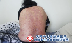 最新银屑病初期鳞屑厚吗？医生建议：实用技巧分享