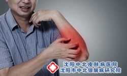 红皮病型牛皮癣诱发因素及症状 三种因素导致病情的出现