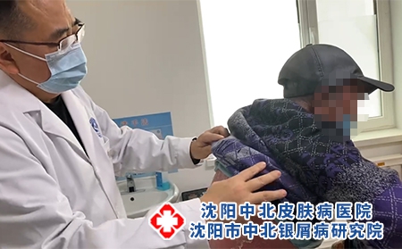 沈阳银屑病哪看好-看牛皮癣沈阳的医院
