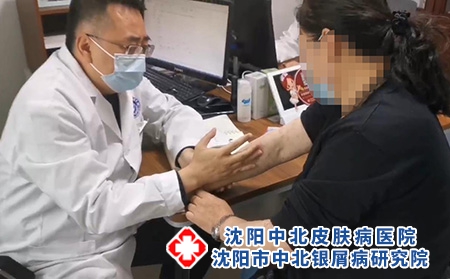 沈阳看银屑病费用-沈阳市中北银屑病研究院-沈阳哪治疗银屑病好
