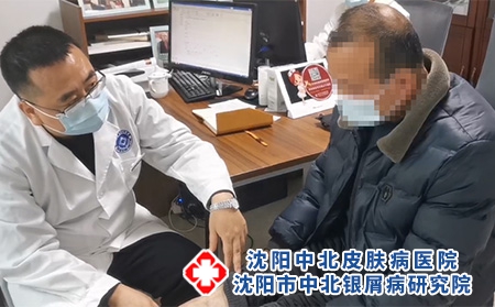 沈阳哪里看银屑病-沈阳市中北银屑病研究院-沈阳哪家专治银屑病