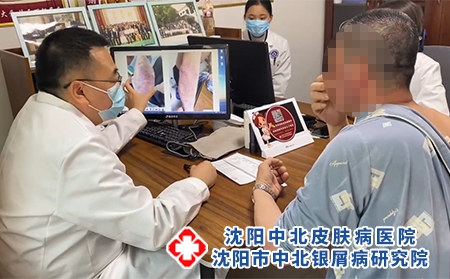 沈阳哪治银屑病好-沈阳中北银屑病研究院-沈阳治疗银屑病去哪 沈阳哪治银屑病好-沈阳中北银屑病研究院-沈阳治疗银屑病去哪
