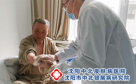 辽宁银屑病患者推荐医院 - 沈阳中北医院