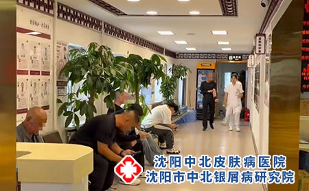 沈阳孙金奎诊疗牛皮癣 - 沈阳中北医院