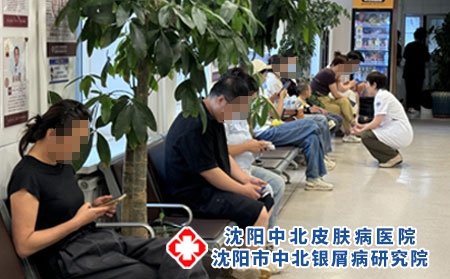 沈阳银屑病抗复发治疗 - 沈阳中北医院 沈阳银屑病抗复发治疗 - 沈阳中北医院