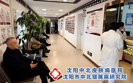 辽宁牛皮癣省内连锁皮肤专科总院-沈阳中北医院 辽宁牛皮癣省内连锁皮肤专科总院-沈阳中北医院