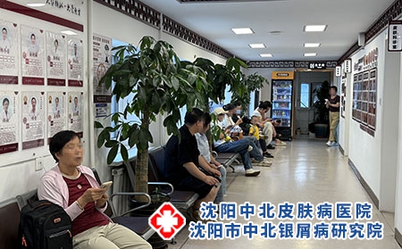 辽宁银屑病正规诊疗机构-沈阳中北医院 辽宁银屑病正规诊疗机构-沈阳中北医院