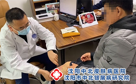 辽宁银屑病口碑好的专科医院---沈阳中北医院 辽宁银屑病口碑好的专科医院---沈阳中北医院