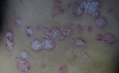 银屑病患者如何护理呢
