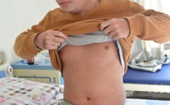 青少年银屑病患者要做好什么护理工作