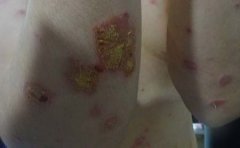 银屑病患者在生活中怎样进行护理