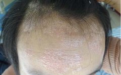 怎样预防银屑病遗传给下一代