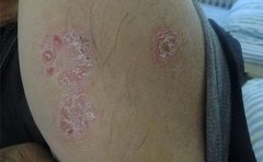 如何防止牛皮癣疾病出现扩散现象