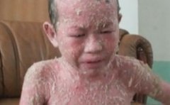 怎样降低牛皮癣遗传几率