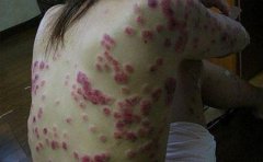预防银屑病的措施是什么