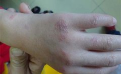 小儿银屑病都有什么原因呢