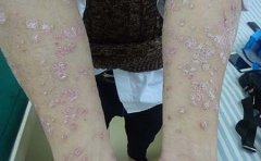 银屑病对人体健康有什么危害