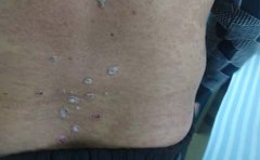 银屑病患者应该怎样洗浴?