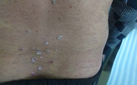 银屑病患者应该怎样洗浴