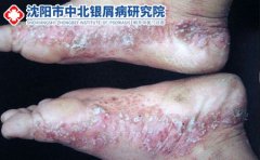 脚气反复发作的原因有哪些
