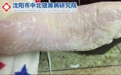 脚气有哪些危害传染吗如何预防