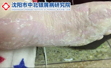 脚气危害,脚气有哪些危害,脚气的危害,脚气传染吗