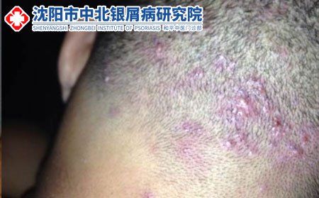 毛囊炎的危害有哪些呢