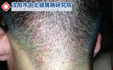 毛囊炎的病因,毛囊炎病因有哪些