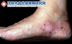 脚气有哪些事项需要注意