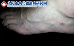脚气出现的原因是什么造成的