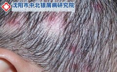 患上毛囊炎要如何治疗