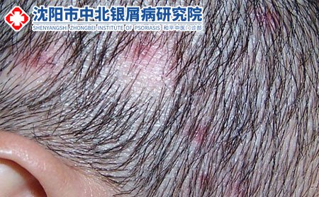 患上毛囊炎要如何治疗