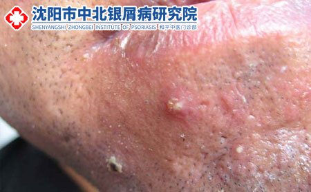 患上毛囊炎我该怎么办