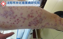 如何通过食物来治疗和预防银屑病复发?