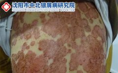 洗浴预防治疗银屑病?