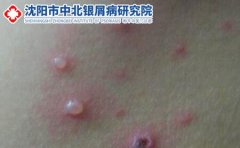 治疗、预防水痘怎么做?