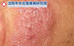 关于湿疹的简单常识和日常护理