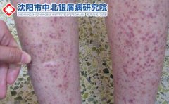 关于紫癜知多少