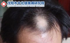 关于脱发的知识，你了解多少?