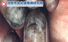你对灰指甲的了解有多少？