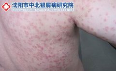 玫瑰糠疹的简单介绍