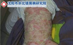 银屑病的几种分类及临床表现